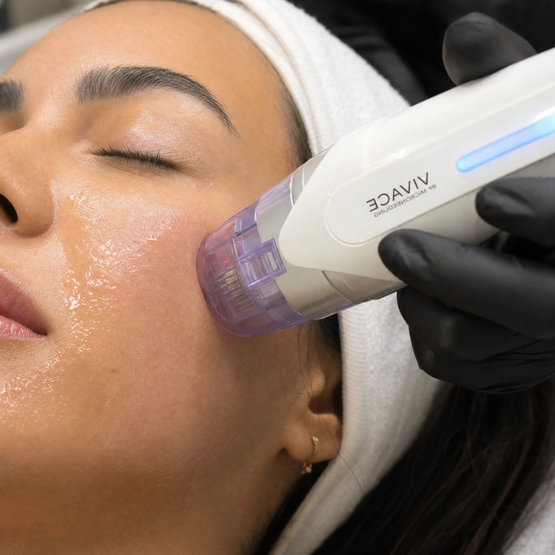 RF microneedling-handstycke i en modern dermatologklinik